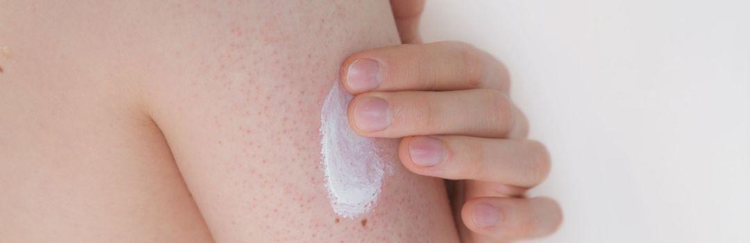 Keratose pilaris: what is and how to solve it?